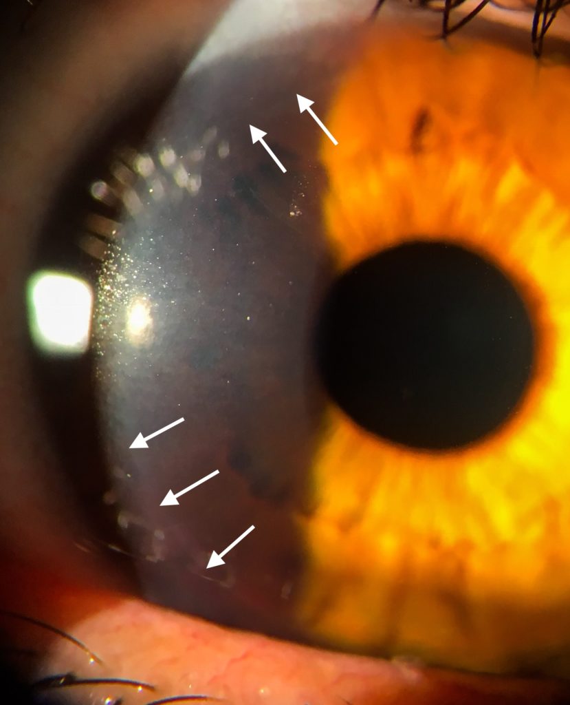 Rohovka po laserové refrakční operaci - LASIK - Laserová operace očí - také takto se dá řešit myopia