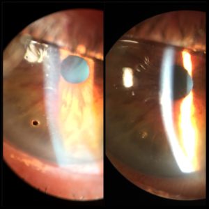 corneal foreign body