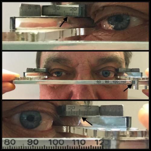 Exophthalmus levého oka, Hertelův exophthalmometr