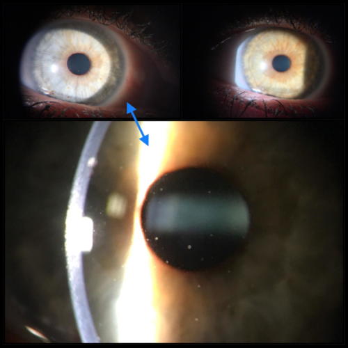Iridocyklitida - Fuchsova heterochromní 