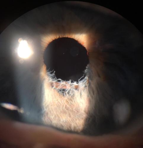 Iris bite