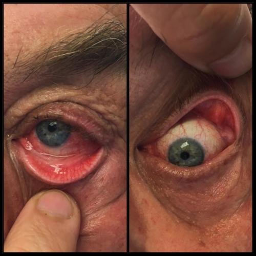 Floppy eyelid syndrome