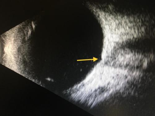 Velká exkavace disku zrakového nervu viditelná při ultrazvukovém vyšetření