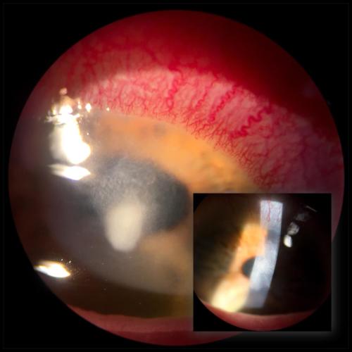 Contact lens - associated keratitis