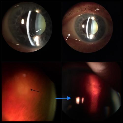 Uveitis - suspekce na Toxoplasmosu