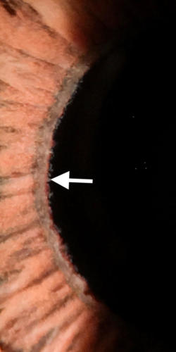 PEX syndrom