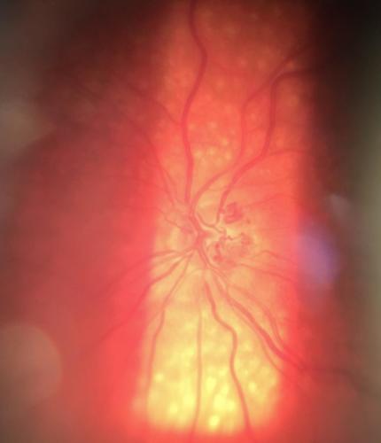 Zrakový nerv s kolaterálami